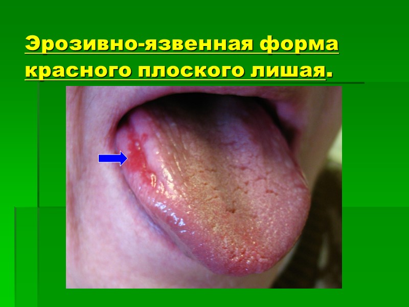 Эрозивно-язвенная форма красного плоского лишая.